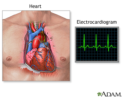 Normal ECG tracing showing P wave, QRS complex, and T wave