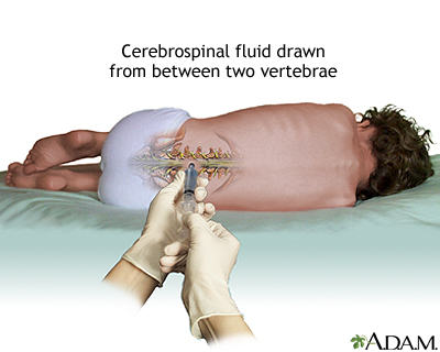 Lumbar puncture procedure showing patient in lateral decubitus position with spinal needle