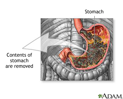 Nasogastric tube placement showing tube inserted through nose into stomach