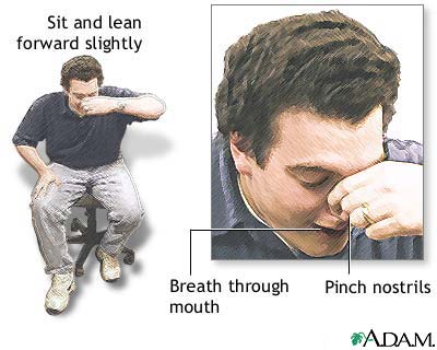 Nosebleed illustration showing blood flow from anterior nasal septum