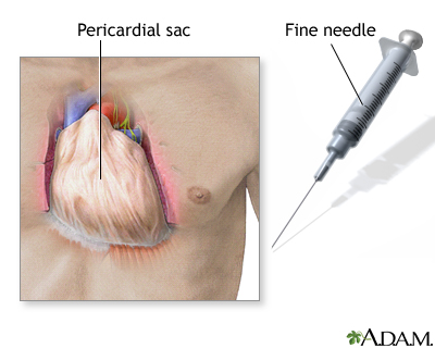 Pericardium anatomy showing fibrous and serous layers surrounding the heart