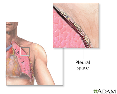 Pleural cavity anatomy showing visceral and parietal pleura layers