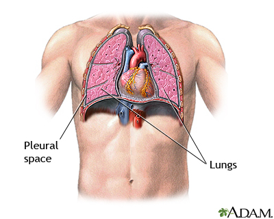 Normal lung anatomy versus pneumothorax showing air in the pleural space