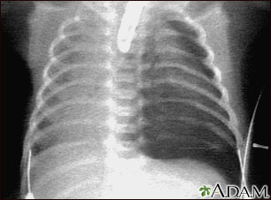 Chest X-ray showing pneumothorax with visible lung edge