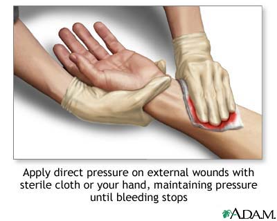 Direct pressure technique to control bleeding