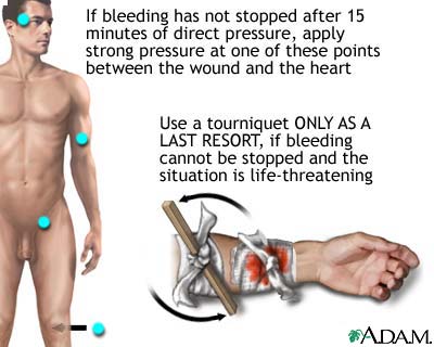 Tourniquet application for hemorrhage control