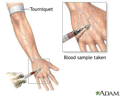 Venipuncture technique showing needle insertion into a vein