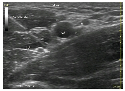 Ultrasound and schematic diagram of the axillary brachial plexus showing the median, ulnar, and radial nerves around the axillary artery