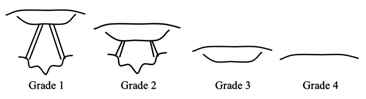 Cormack-Lehane laryngoscopic view grading system showing Grades I through IV