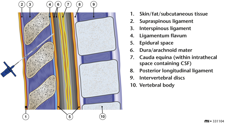 Cross-sectional view showing the epidural needle path through tissue layers to reach the epidural space