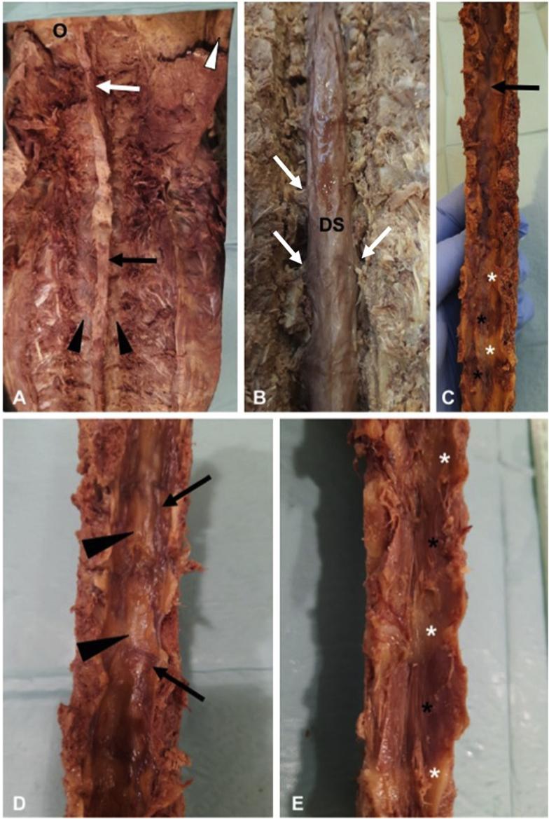 Detailed anatomy of the epidural space showing its contents and boundaries