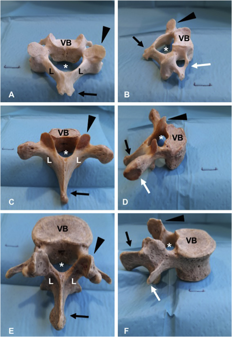 Cross-sectional and sagittal view of vertebral anatomy showing the epidural space, ligaments, and meninges relevant to neuraxial anesthesia