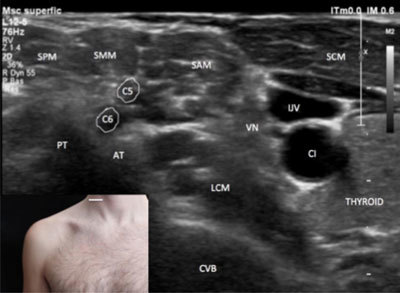 Ultrasound image of the interscalene brachial plexus showing the stoplight sign with nerve trunks between the anterior and middle scalene muscles