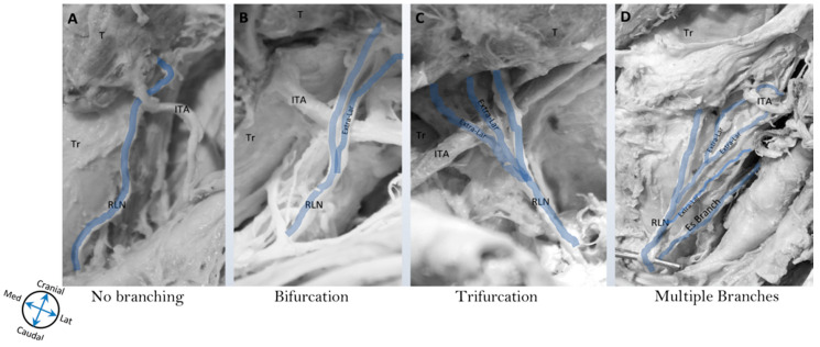 Anatomy of the recurrent laryngeal nerves and their relationship to the vagus nerve, carotid arteries, and subclavian arteries