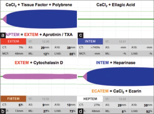 Subtypes of rotational thromboelastometry (ROTEM) showing EXTEM, INTEM, FIBTEM, and APTEM assays