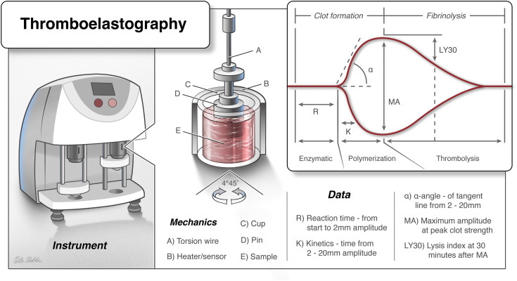 Mechanical setup of thromboelastography showing the pin suspended in a blood sample cup and the resulting tracing