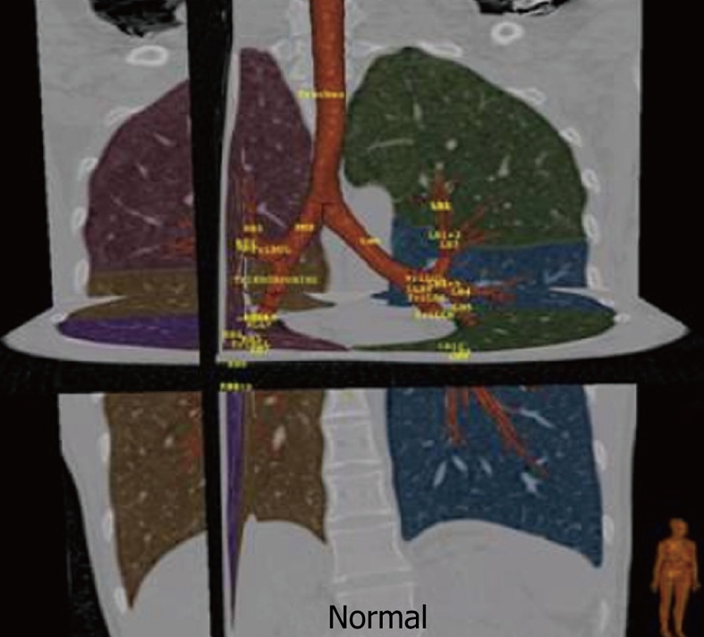Tracheobronchial tree anatomy showing the trachea, carina, right and left mainstem bronchi, and associated lymphatic structures