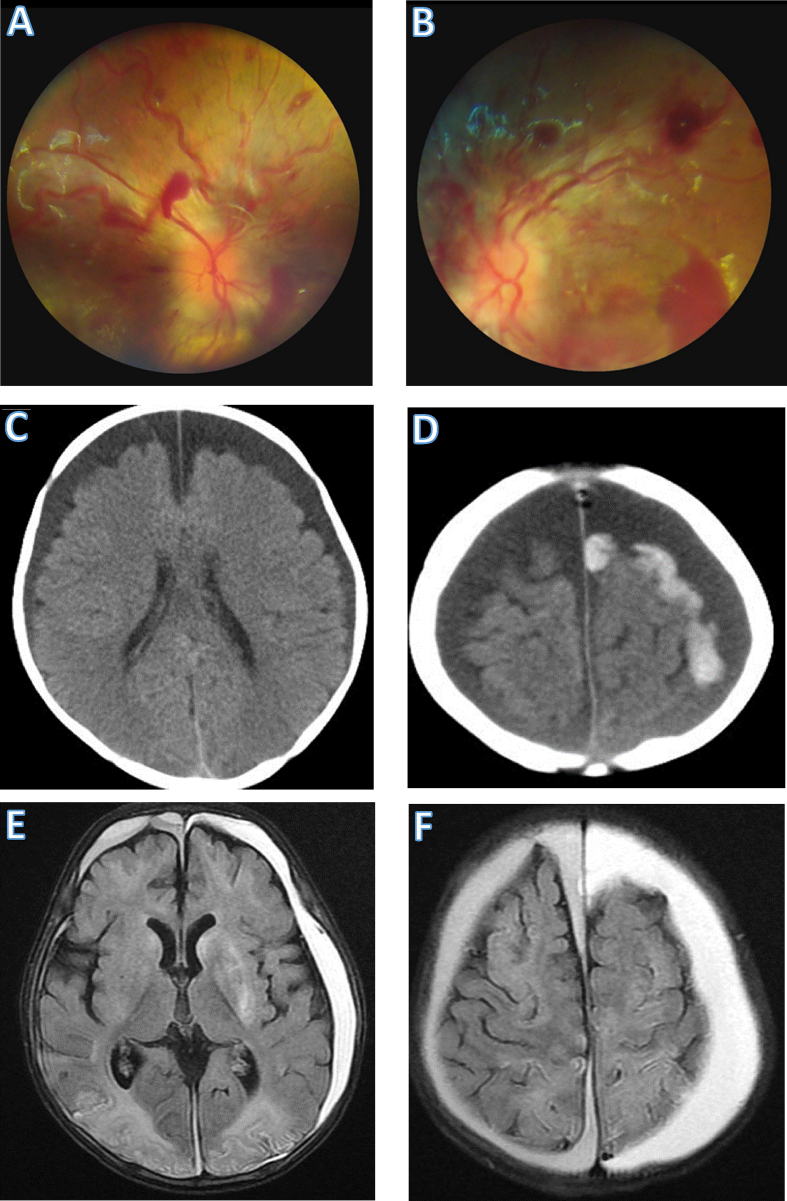 MRI of an 8-month-old infant with abusive head trauma showing subdural hemorrhage and brain injury