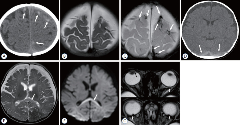 MRI of a 3-month-old infant showing chronic subdural hematoma from abusive head trauma with T1 and T2 weighted sequences