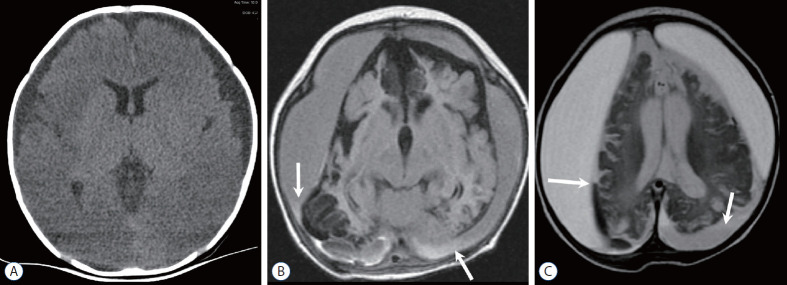 CT scan showing subdural hematoma in an infant with abusive head trauma, with arrow indicating the hemorrhage