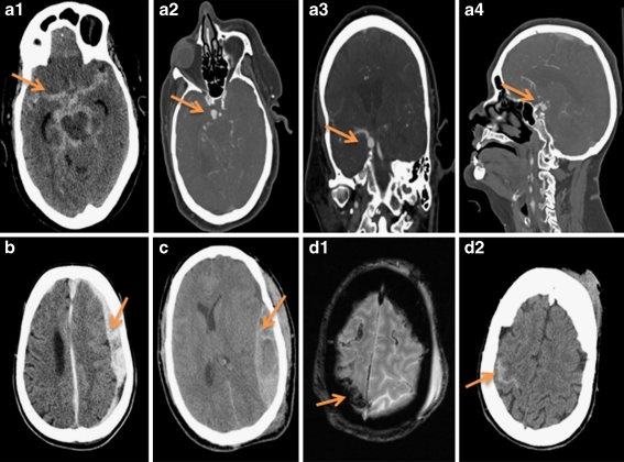 Diagram showing Battle sign (retroauricular ecchymosis) and raccoon eyes (periorbital ecchymosis) as clinical indicators of basilar skull fracture