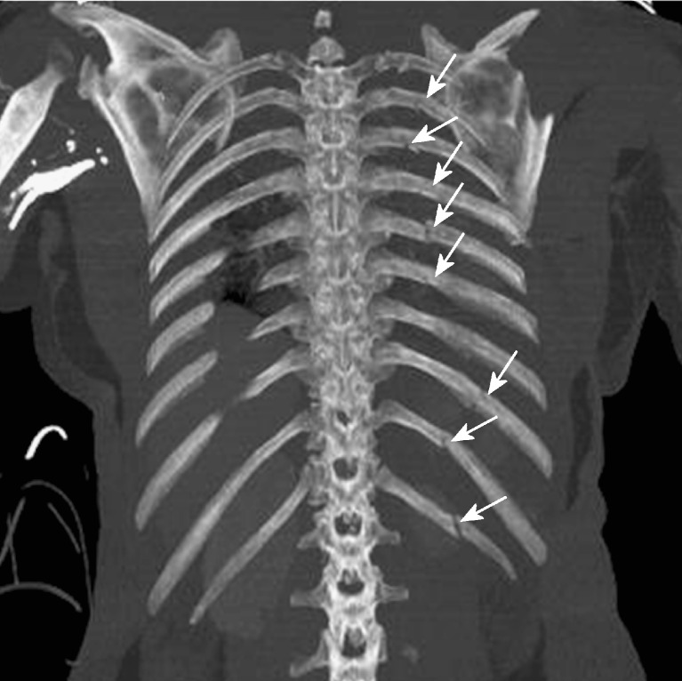 CT scan showing cardiac rupture from blunt chest trauma