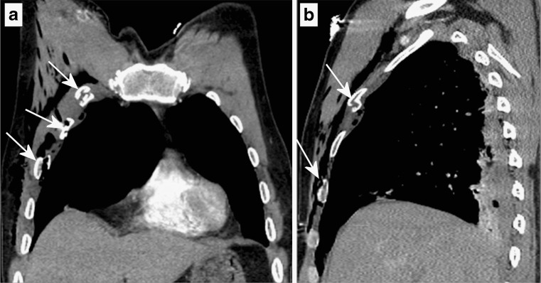 Chest radiograph showing injuries from blunt chest trauma including rib fractures