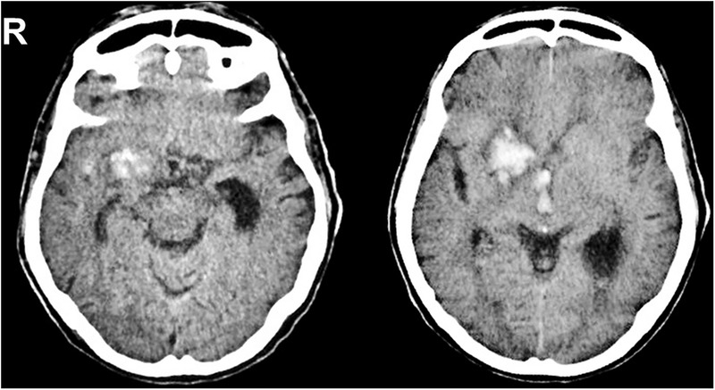 CT scan showing intracranial hemorrhage in the caudate region of the brain