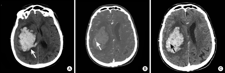 CT and gross specimen showing chronic hypertensive hemorrhage in the brain