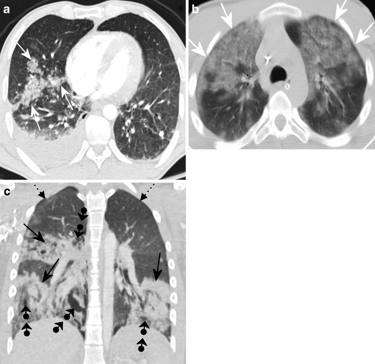 Contusion of the right lateral chest beneath the axilla showing subcutaneous hemorrhage from blunt force impact