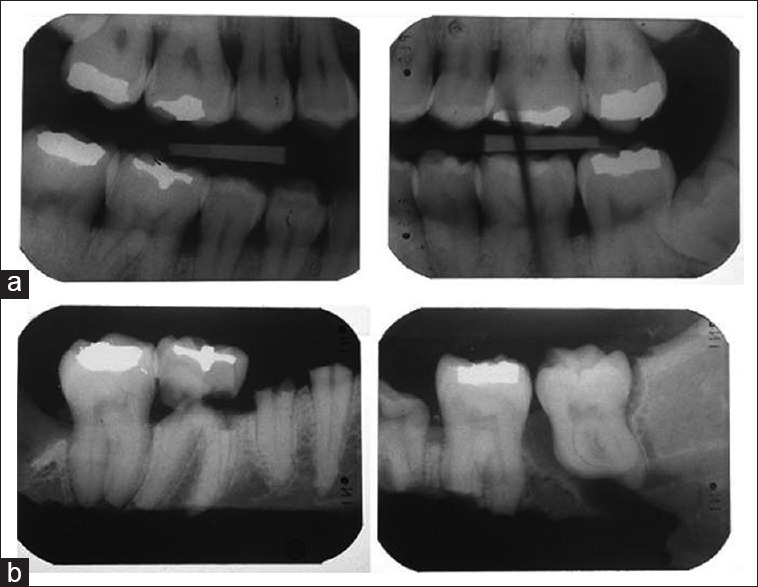 Comparison of antemortem and postmortem dental bite-wing radiographs used for forensic victim identification