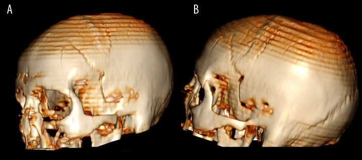 CT scan showing epidural hematoma with associated skull fracture, demonstrating typical findings in head trauma from vehicular accidents or falls