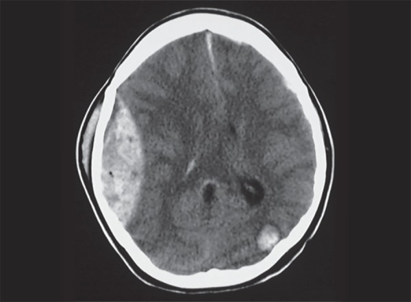 CT scan showing right frontal epidural hematoma as a biconvex hyperdense lesion that does not cross suture lines