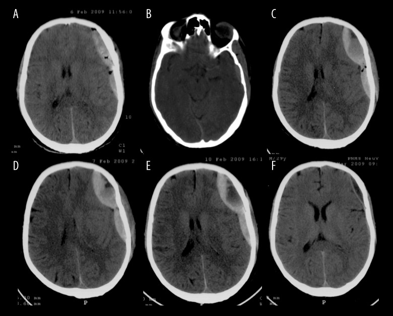 CT scan with epidural hematoma highlighted in red overlay showing biconvex morphology