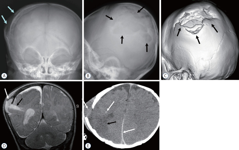 3D CT reconstruction showing pediatric skull fracture patterns