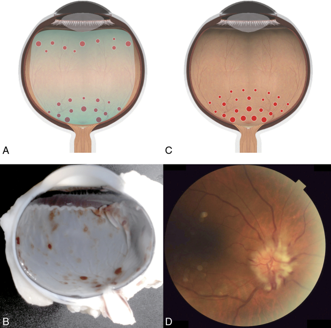 Grade 3b retinal hemorrhage showing severe multilayered hemorrhages extending to the periphery with retinoschisis