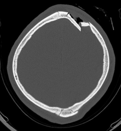 Skull radiograph showing a depressed fracture of the parietal bone