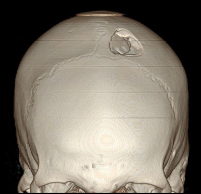 Skull radiograph showing a linear parietal bone fracture