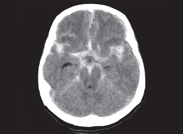 CT scan showing subarachnoid hemorrhage with hyperdensity in the sulci and basal cisterns