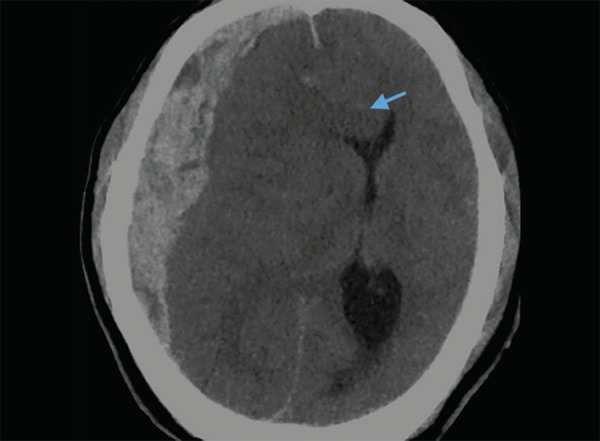 CT scan showing subdural hematoma as a crescent-shaped hyperdense collection that crosses suture lines and follows brain contour