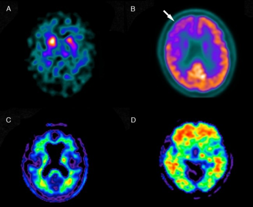 Amyloid PET brain scans comparing negative (normal) and positive (Alzheimer disease) amyloid deposition patterns