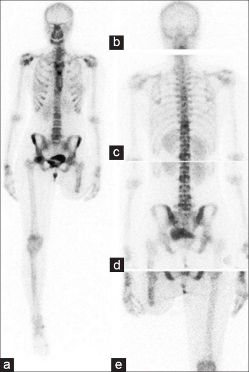Tc-99m MDP whole-body bone scan showing multiple foci of increased uptake consistent with skeletal metastases