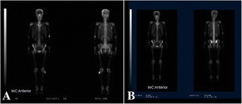 Serial bone scans showing progression and response of skeletal metastases in a cancer patient