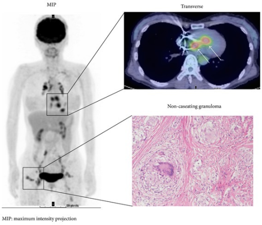 FDG PET/CT showing focal myocardial FDG uptake in cardiac sarcoidosis with mediastinal lymphadenopathy