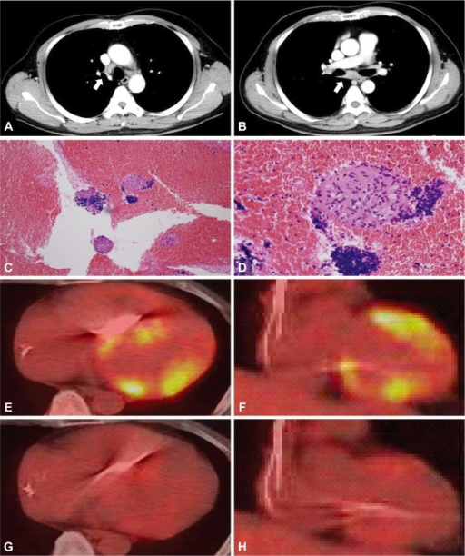 Serial FDG PET images showing reduction in myocardial FDG uptake after steroid therapy for cardiac sarcoidosis