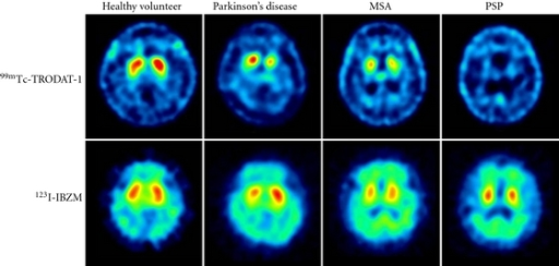 DaTscan images comparing normal comma-shaped striatal uptake with abnormal decreased uptake patterns in Parkinsonian syndromes
