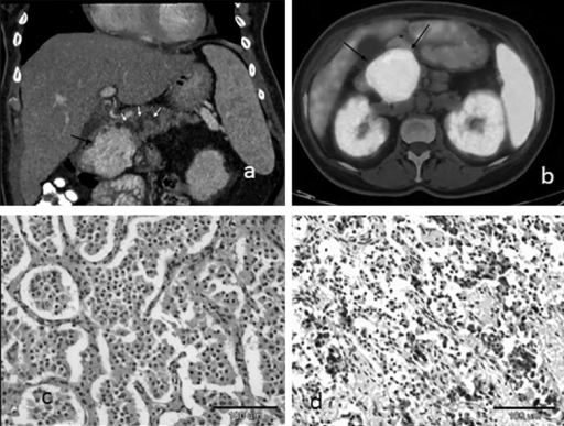 Ga-68 DOTATATE PET/CT showing a somatostatin receptor-positive neuroendocrine tumor with intense uptake
