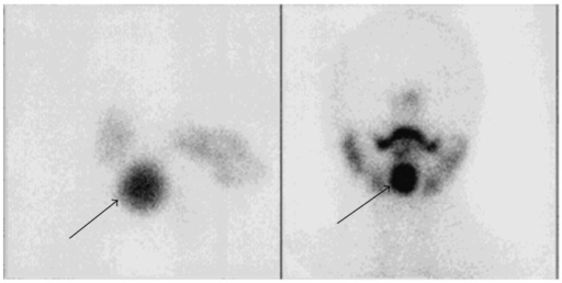Thyroid scintigraphy showing ectopic lingual thyroid tissue with intense radiotracer uptake at the base of the tongue