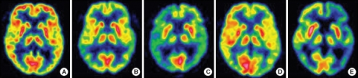 FDG PET brain scans showing bilateral temporoparietal hypometabolism in Alzheimer disease compared to normal aging