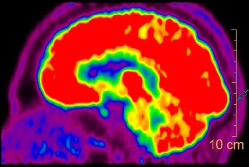 FDG PET brain scan showing temporoparietal and precuneus hypometabolism characteristic of Alzheimer disease